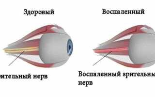 Причины и лечение куриной слепоты