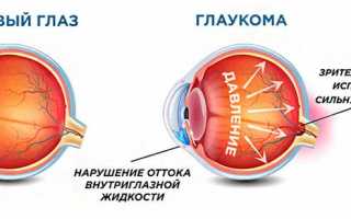 Причины непроходимости слёзного канала, симптомы, диагностика и лечение