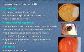 Лечение вторичной катаракты после замены хрусталика
