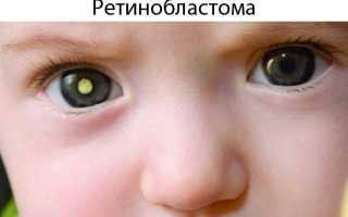 Назначение сетчатки глаза и её патологии