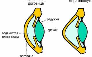 Признаки и методы лечения смешанного астигматизма