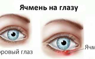 Разновидности и эффективность заговоров от ячменя на глазу