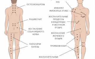 Гирудотерапия — лечение пиявками
