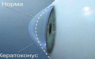 Особенности лечения миопии средней степени