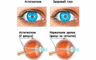 Поддаётся ли астигматизм лечению