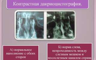 Назначение и патологии слёзного мясца