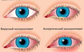 Признаки, симптомы и лечение острого конъюнктивита